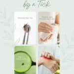 What to do if you are bitten by a tick.